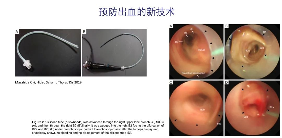 经皮肺穿刺活检术过程,经支气管冷冻肺活检