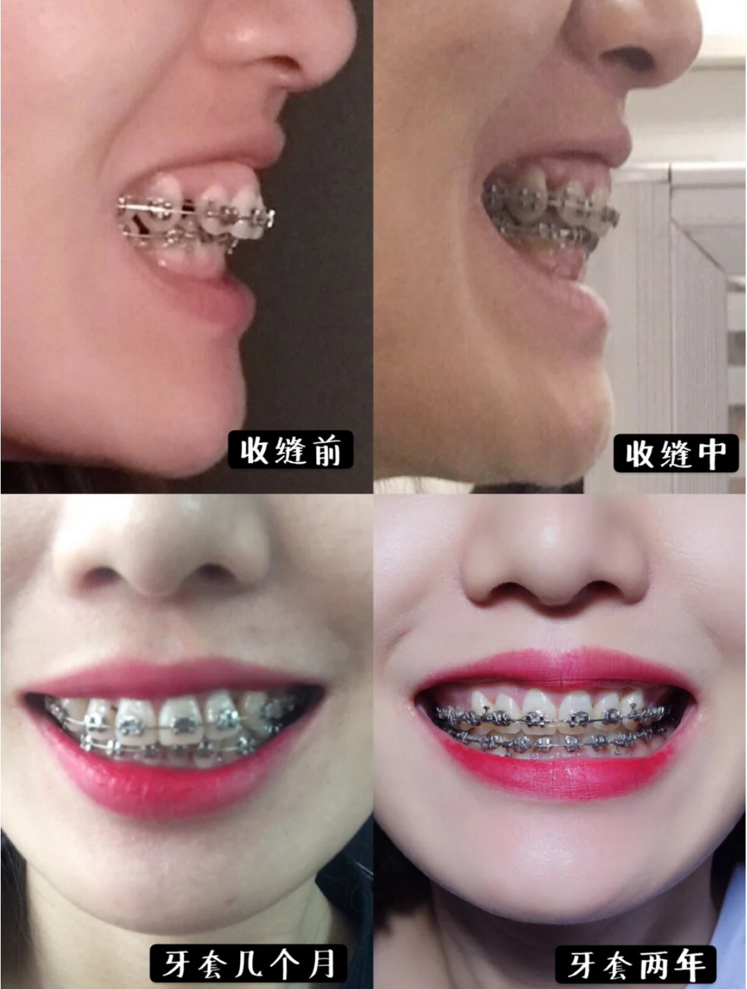 整牙讲解,整牙一定要问的问题