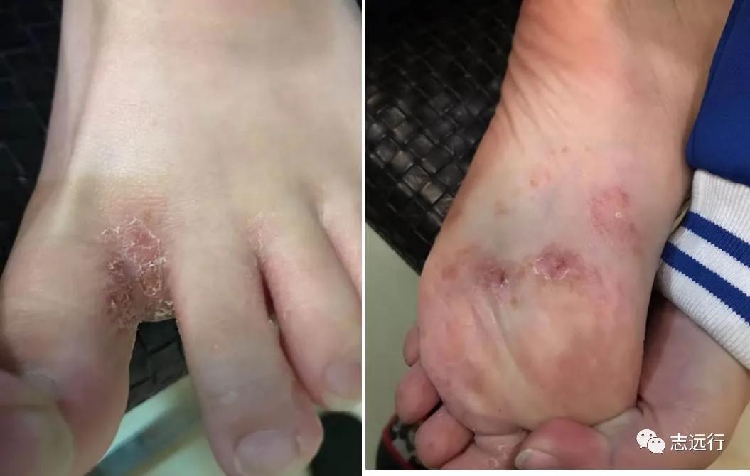 张景明治疗手足癣的中药方,手足癣单方大全