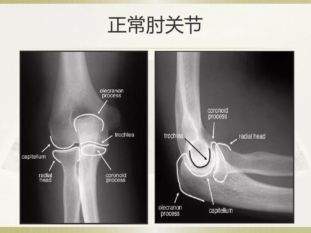 骨科x光片读片技巧,放射科骨科读片教程
