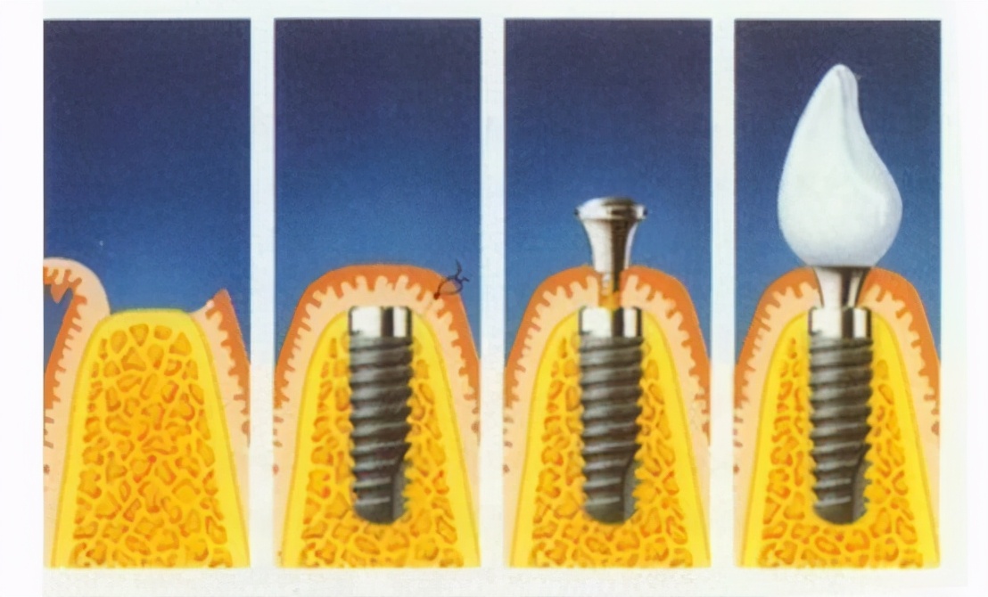 雅悦齿科能恢复牙齿吗,种植牙去医院好还是去康美齿科好