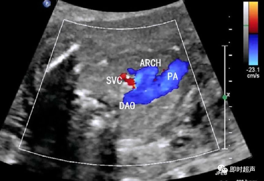 胎儿心脏三种血管关系模式图,25周的胎儿心脏弓切面多少正常