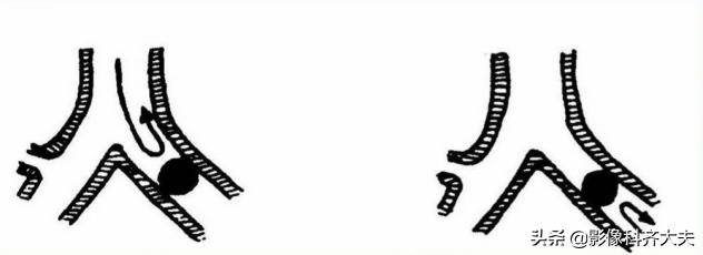 小儿气管镜怎么检查,小儿ct检查全过程视频