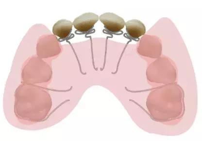 小朋友牙齿地包天矫正方法,牙齿地包天多大矫正最合适