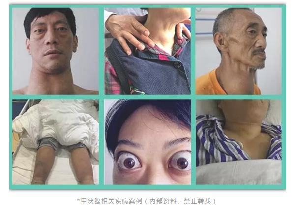 缺碘导致甲状腺结节多大能自愈,甲状腺结节tirads分级3级会自愈吗