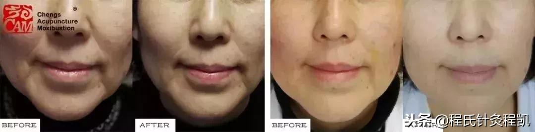 最新不踩坑的脸部美容项目方法,最新日本美容项目提拉方法