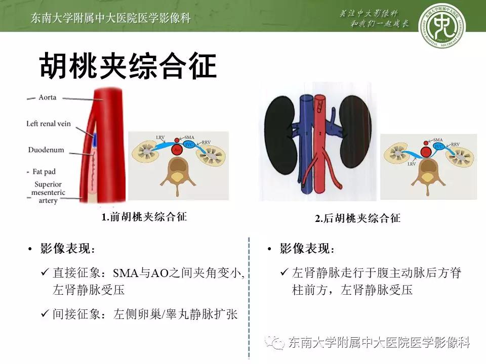 肠系膜上动脉压迫综合征挂什么科,肠系膜上动脉压迫综合征手术费用