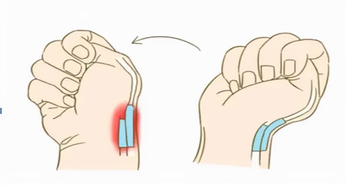 健康鼠标手怎么缓解专家来教您,白领鼠标手腕管综合征