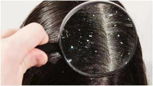 梦禾科普｜如何对付烦人的头皮屑