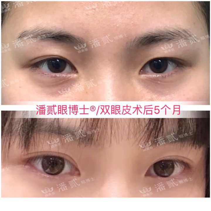 割了开扇双眼皮眼尾上扬太宽,眼尾上扬的眼睛适合什么双眼皮