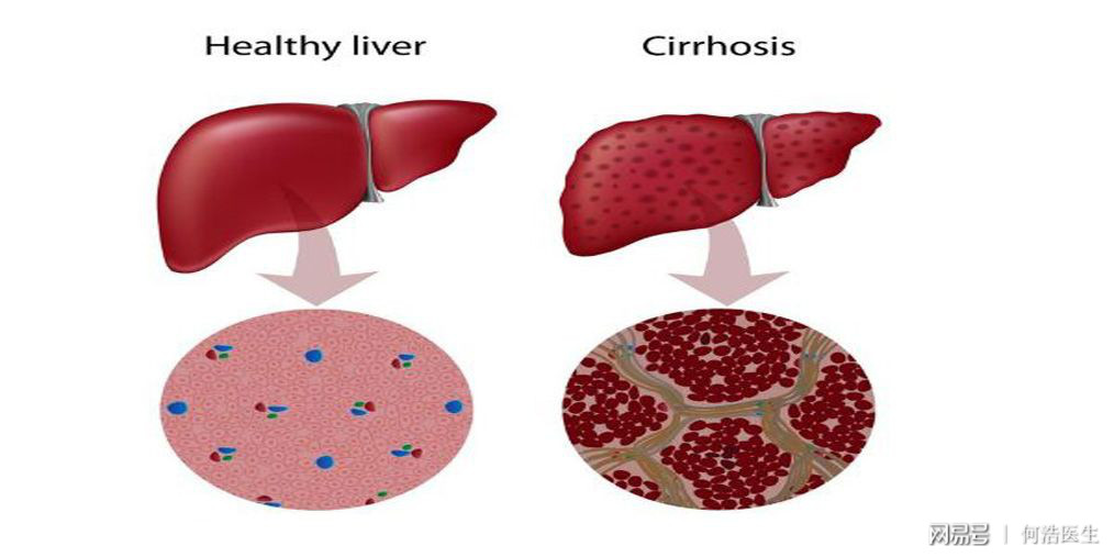 肝硬化皮肤瘙痒中医辨证,中医辨证治疗肝硬化腹水