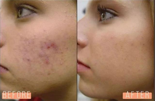 为什么痘印祛不了,为什么痘印去除不了