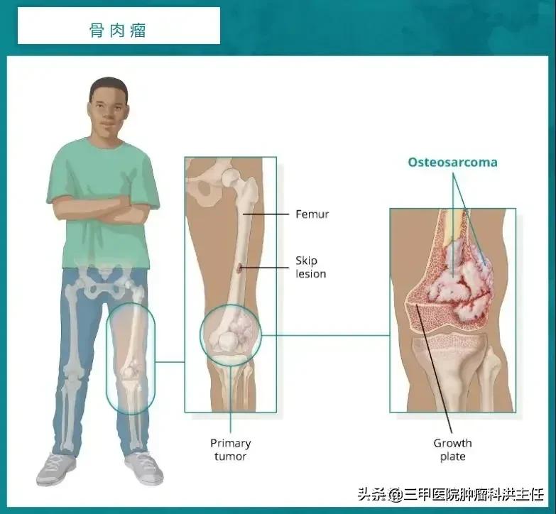上肢疼痛怀疑扭伤，结果竟检查出恶性骨肉瘤