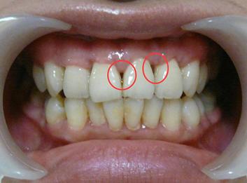 你的牙龈健康吗，5个方面自我检查