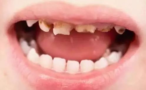小孩得了奶瓶龋该怎么治疗,宝宝牙齿奶瓶龋怎样治