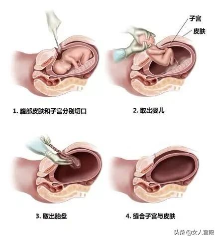 盆底肌松了做什么修复最有效果,产后盆底肌松了怎么办