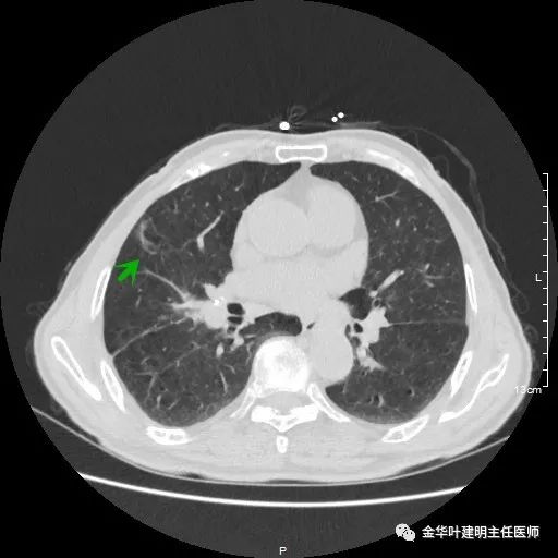 多发原发肺癌能根治吗,肺部原发性恶性肿瘤好治
