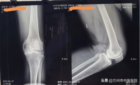 膝痛中医辨证,膝风湿关节痛的治疗方法
