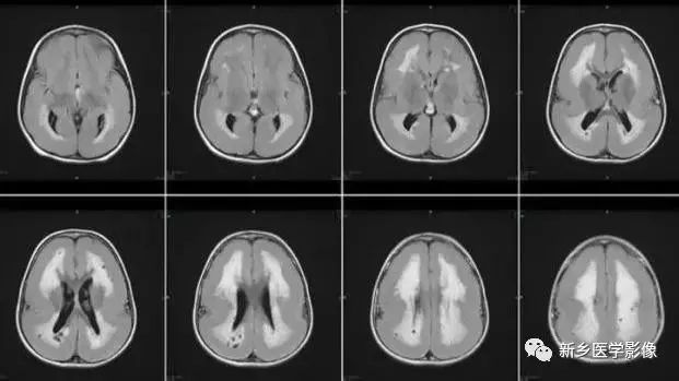 脑室影像学表现,脑室占位影像