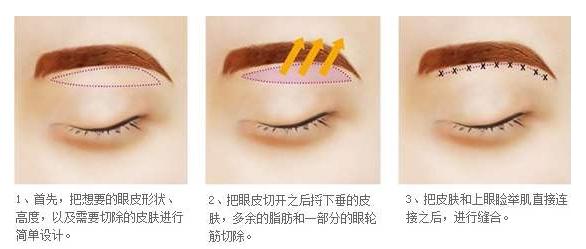 眼皮松弛下垂用金眼霜能改善吗,眼皮松弛下垂最好解决方法