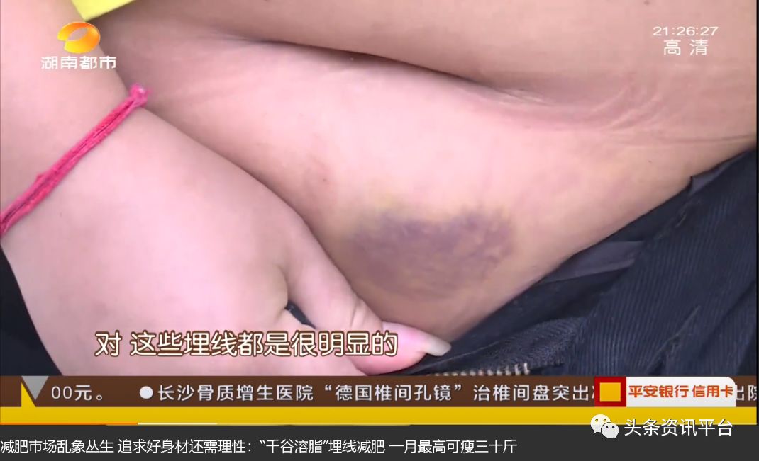 千谷生物,千谷溶脂线是怎么样的产品