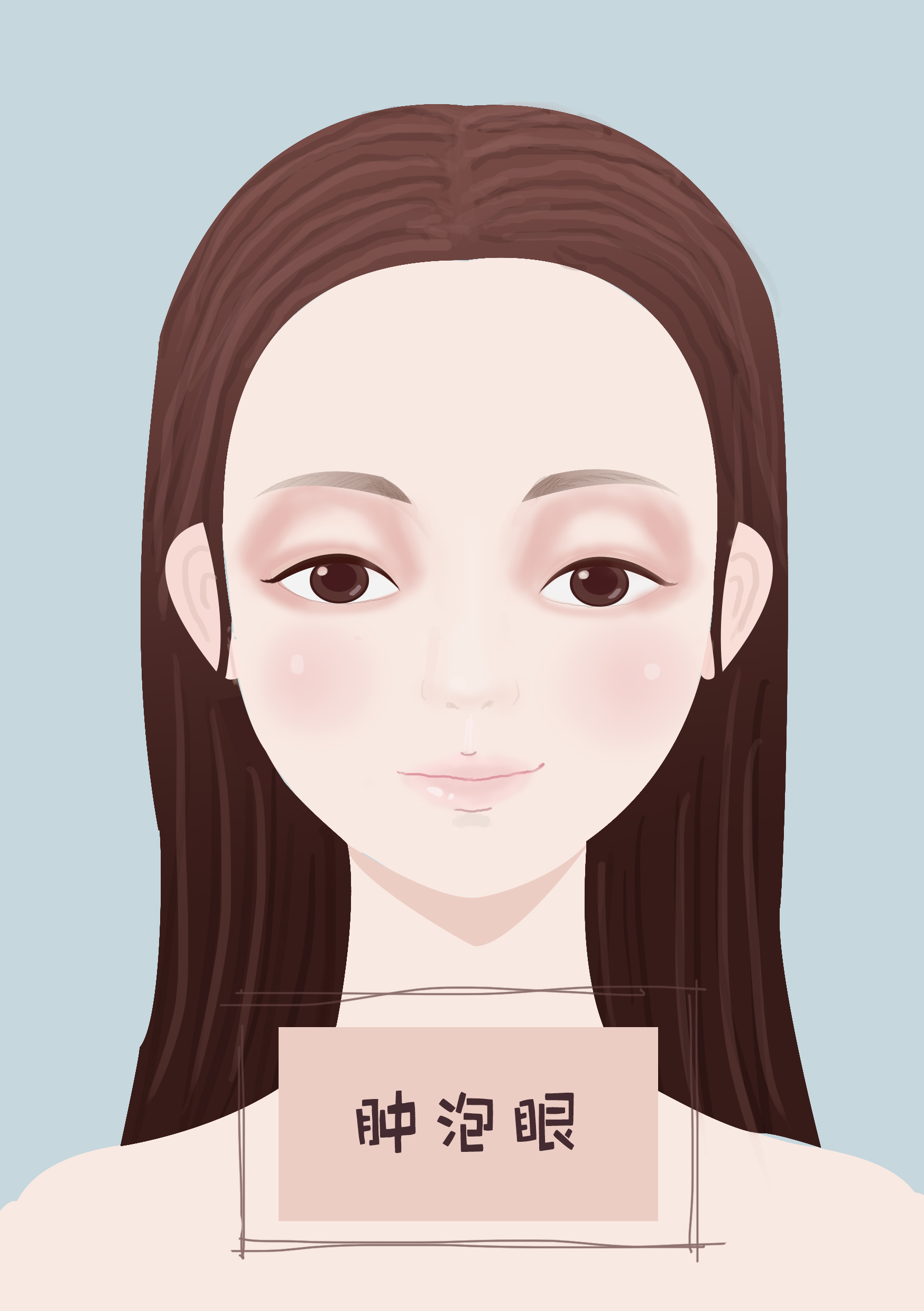 肿泡眼最快治疗方法,肿泡眼自救