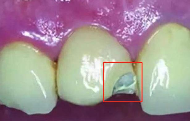 钴铬合金烤瓷牙牙龈变黑怎么处理,烤瓷牙崩瓷了怎么修复