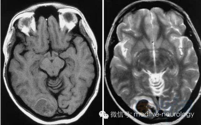 脑出血磁共振t1t2表现,10分钟记住脑出血核磁表现