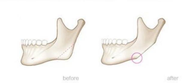 那些一刀切削骨的明星还好吗？后遗症一大堆，小方脸成最大赢家