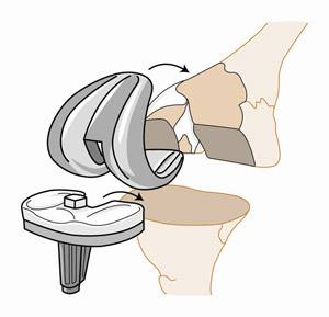 关节炎与痛风性关节炎有什么区别,关于痛风的30个辟谣的问题