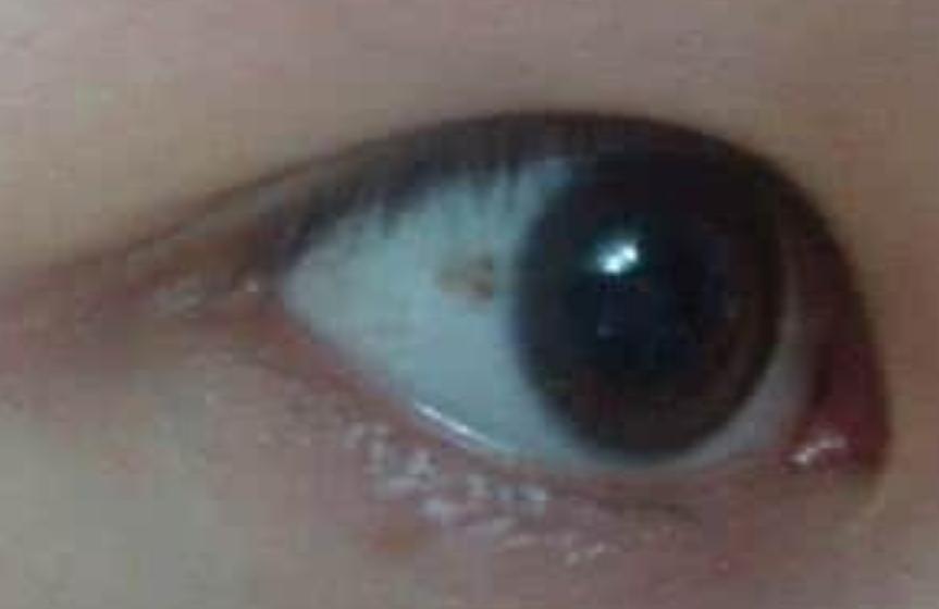 眼白里的小黑斑可以去除吗,宝宝眼白上有小红斑是什么原因