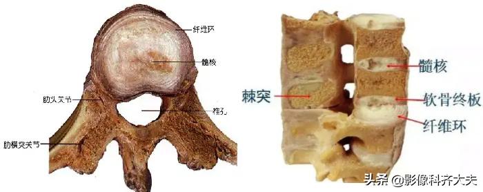 腰椎间盘突出是什么,腰椎间盘突出和腰间盘突出有区别吗