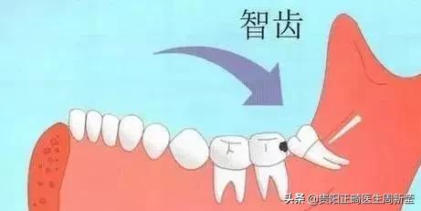 普及一下拔智齿全过程,拔智齿预警看完你再决定要不要拔