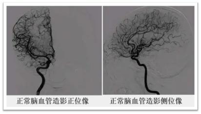 儿童突发左下肢无力,儿童下肢突然无法动弹
