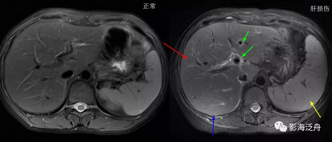 肝脏弥漫性病变严重吗,肝脏弥漫性的病变的症状
