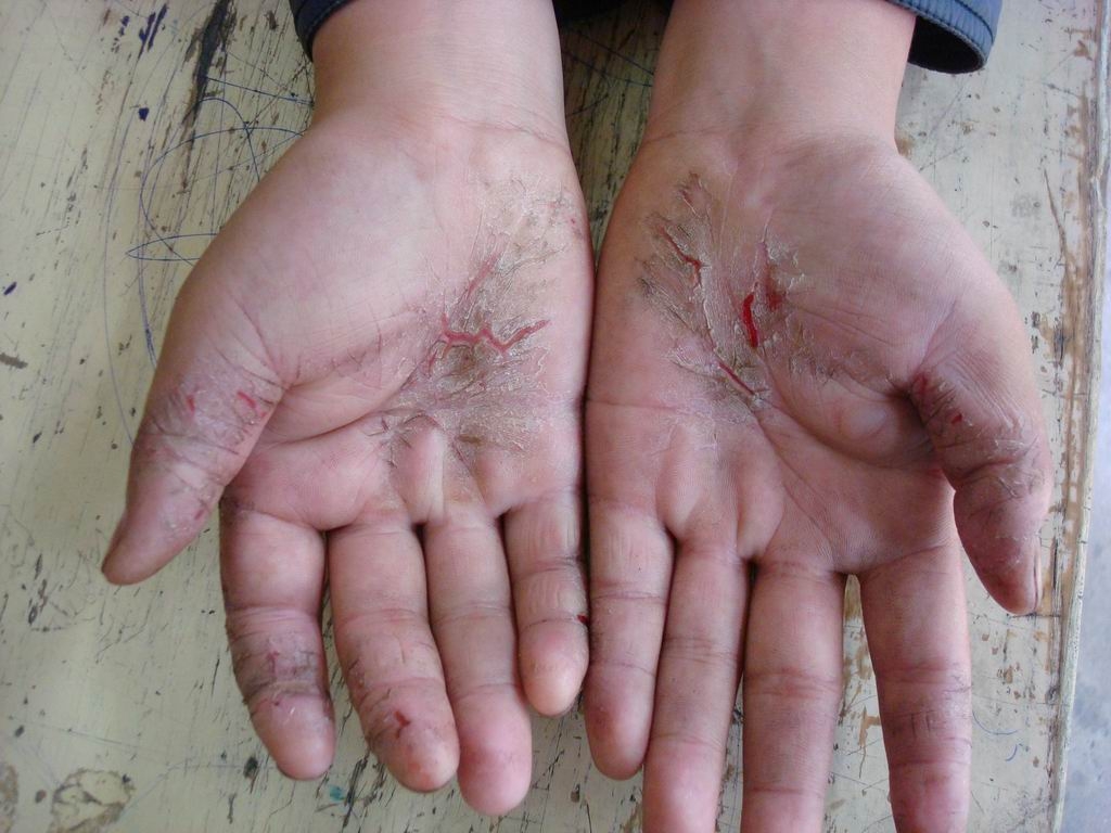 手脚湿疹和癣的区别,手足癣干裂脱皮怎么治