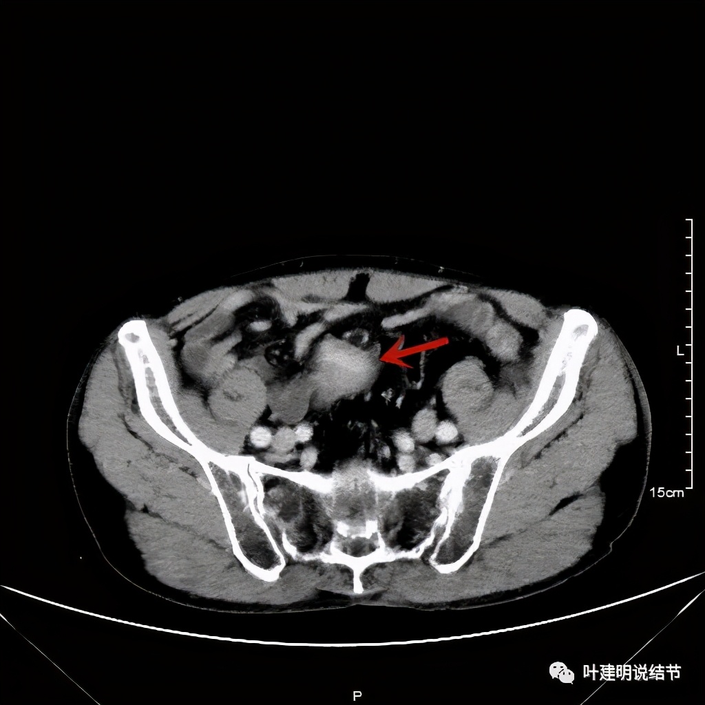 同时患结肠癌和直肠癌怎么办,同时查出了胃癌和肺癌怎么办