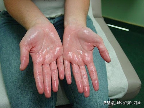 手心为什么总是会出汗,手心容易出汗是阴虚还是阳虚