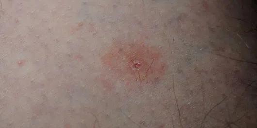 怎么预防在景区被毒虫叮咬,出游当心蜱虫叮咬