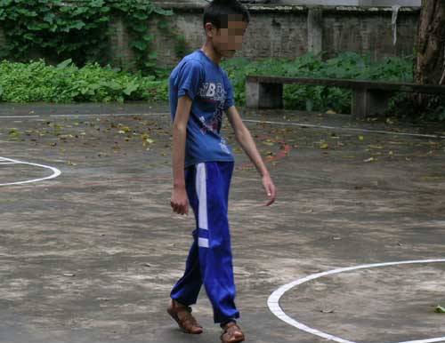 跑步时脚是外八字怎么纠正,膝盖内扣脚外八字跑步