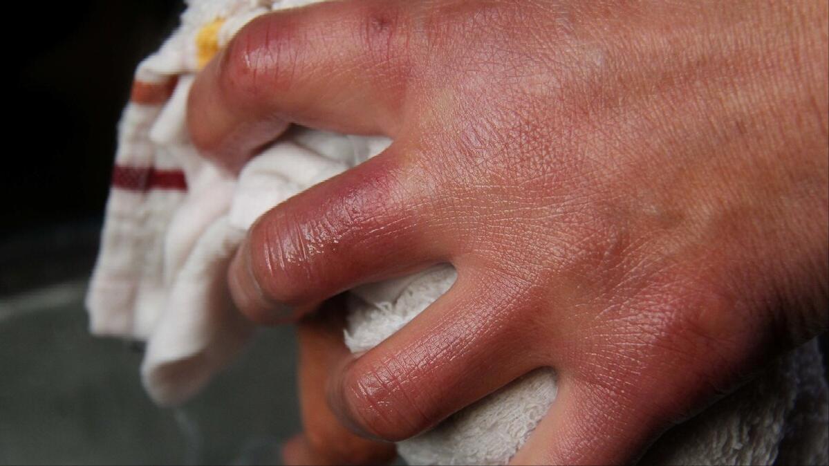 如何告别顽固性冻疮,防治冻疮的小窍门