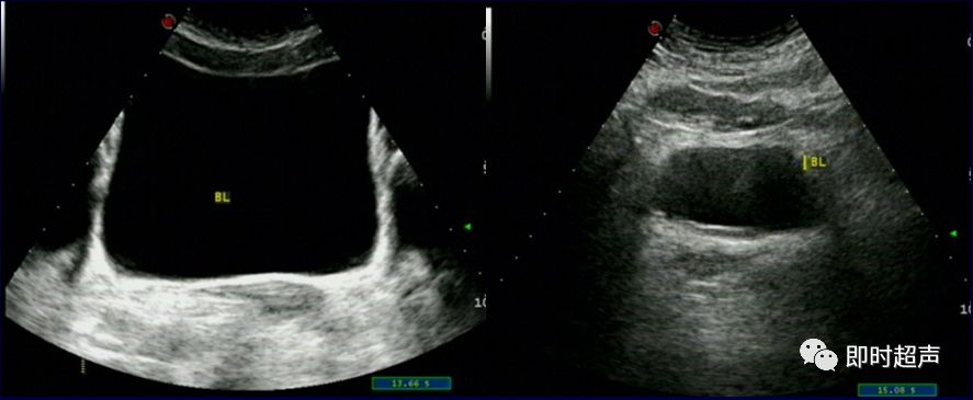 膀胱超声图解大全,膀胱超声解剖及常见病变超声表现