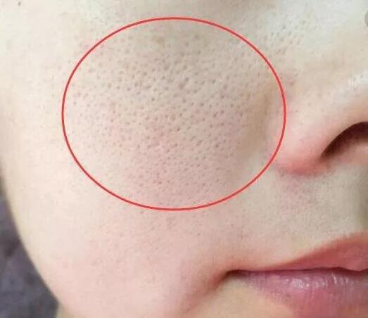 为什么脸上的螨虫反反复复,螨虫最怕什么药脸上有螨虫怎么治