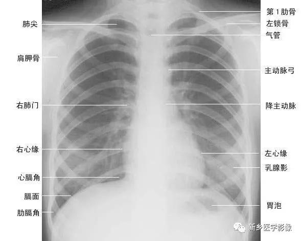 x线影像解剖大全,胸部x线怎么看懂图解