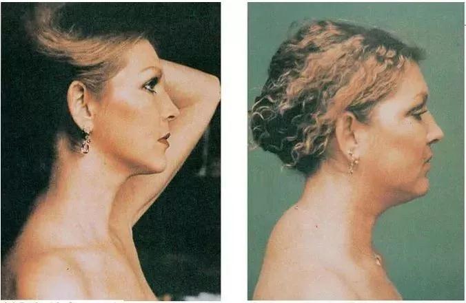 11岁孩子颈椎有个富贵包怎么办,每天10分钟消除颈椎富贵包