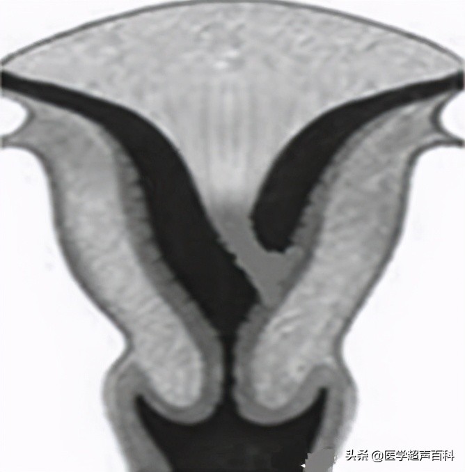 子宫发育正常是否会子宫幼稚,幼稚子宫和子宫发育不良的区别