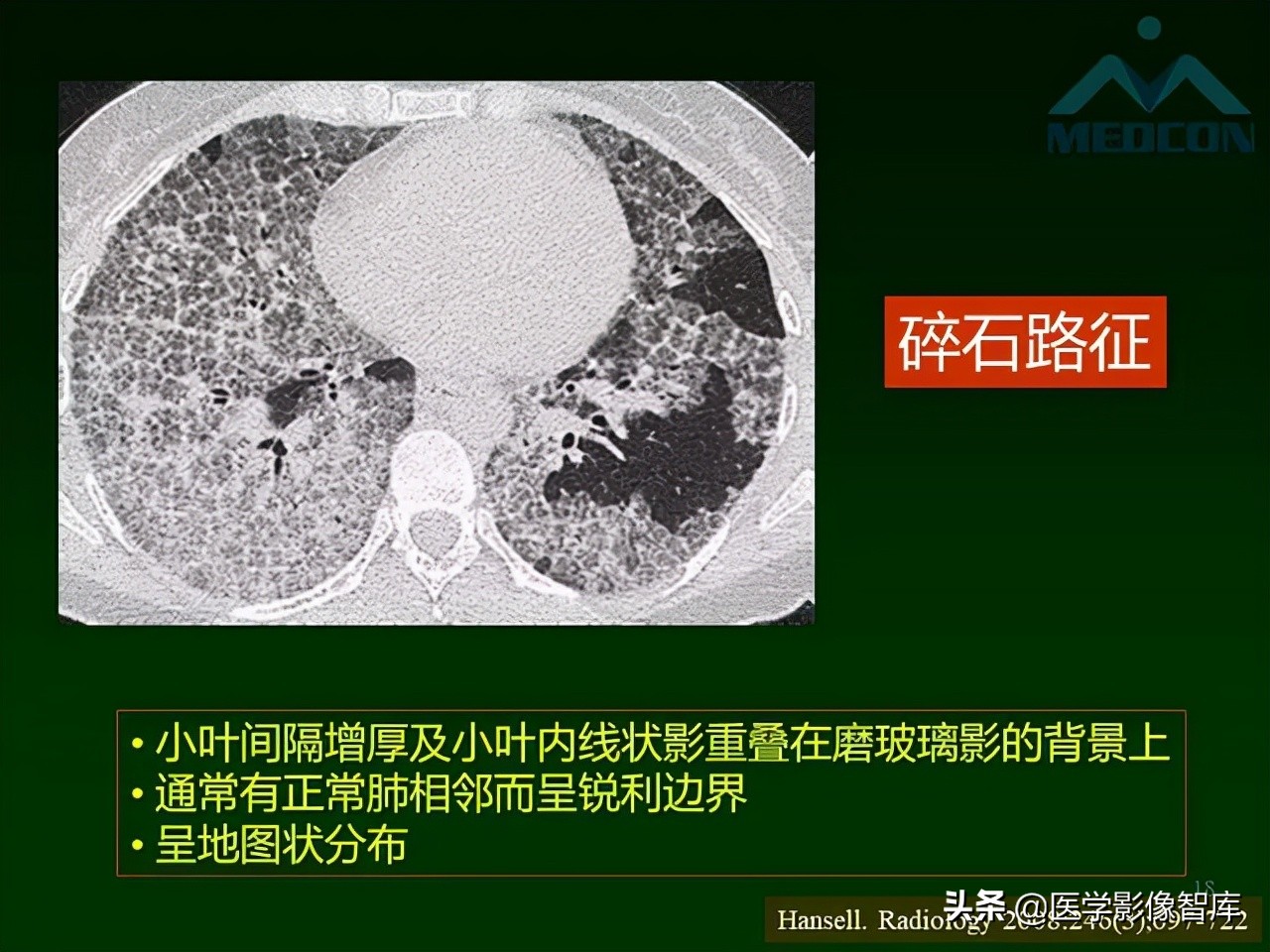 肺弥漫性网状影,两肺小叶间隔增厚可见网状模糊影