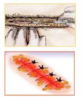 手术之后切口感染要手术吗,手术后感染要多久才能痊愈