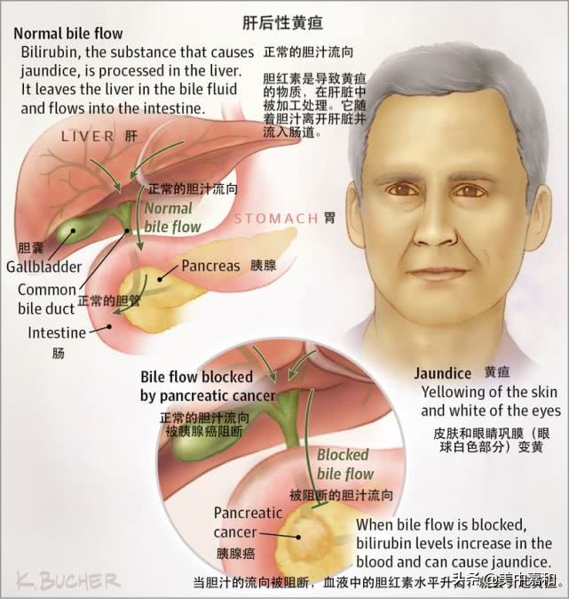 肿瘤性黄疸会有什么症状,肿瘤黄疸高会有什么不舒服