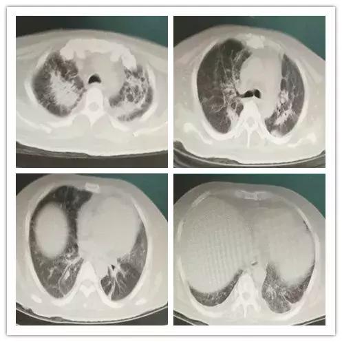 呼吸困难为主要症状的住院大病历,病人出现呼吸困难症状